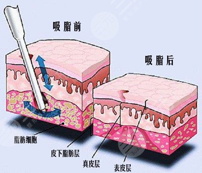 全身吸脂需要多少钱
