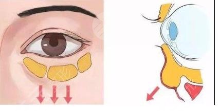 怎样加快眼袋恢复