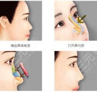 耳软骨垫鼻尖会被吸收吗?科普隆鼻的几种方式 耳软骨垫鼻尖会被吸收吗?科普隆鼻的几种方式