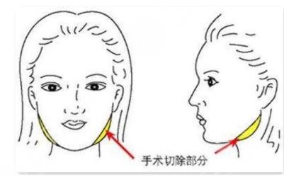 影响削骨瘦脸手术收费的因素
