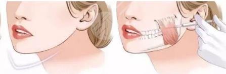 什么是注射瘦脸