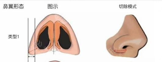 缩鼻翼对比照片