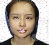 下颌角截骨整形技术|宽大的下颌角终于被修掉了，get柔媚轮廓！