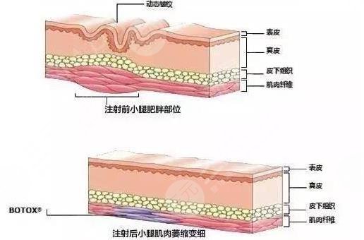 注射瘦腿?的价格与产品质量有关
