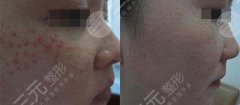 去痘印疤痕有的方法都有哪些？小技巧都学起来！