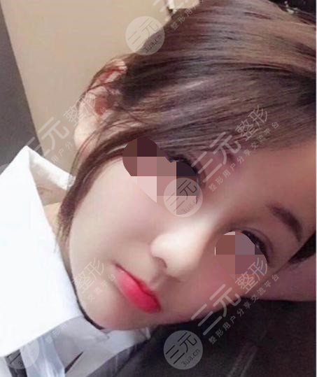 做热玛吉脸上有几个部位