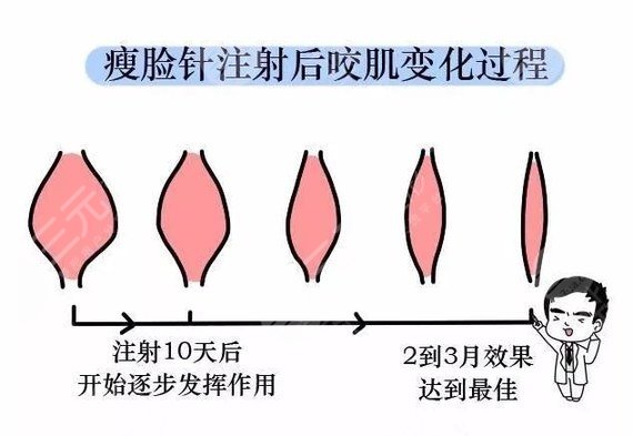 注射瘦脸