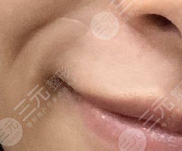 激光祛疤恢复过程图