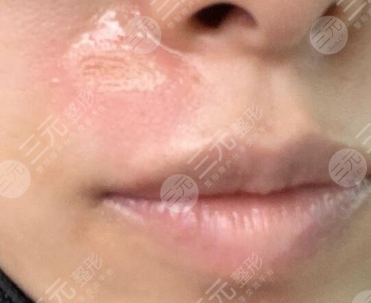 激光祛疤恢复过程图分享！疤痕无影踪，美丽重回来！