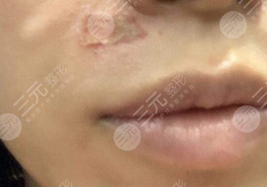 激光祛疤恢复过程图