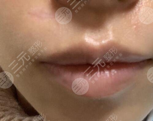 激光祛疤恢复过程图