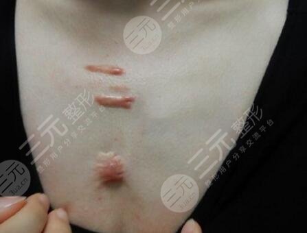 祛疤案例