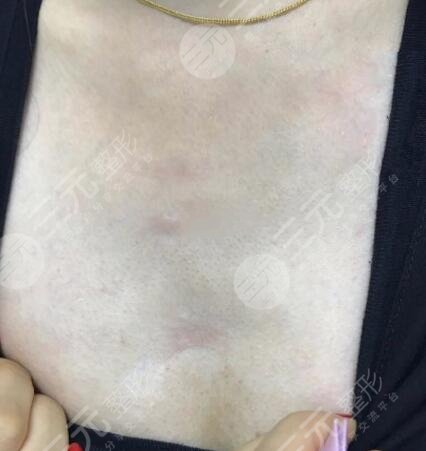 圆形疤痕切除对比照