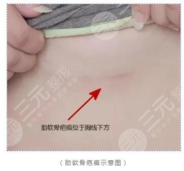 自体软骨隆鼻
