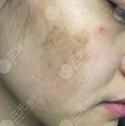激光祛除黄褐斑的果怎么样?日常保养注意事项 激光祛除黄褐斑的果怎么样?日常保养注意事项