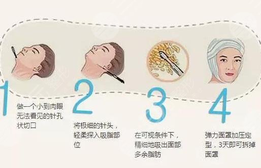 面部吸脂过程