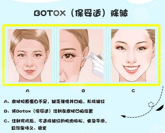 ****注射除皱成好吗