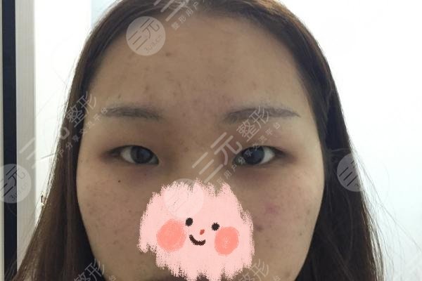 广州天资周祺双眼皮