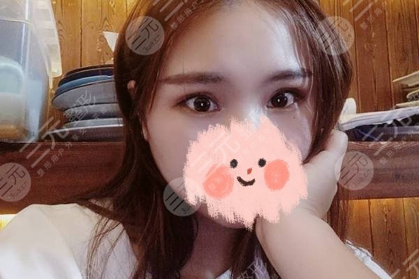 广州天资周祺双眼皮做的怎么样？分享果图，甜美可人！