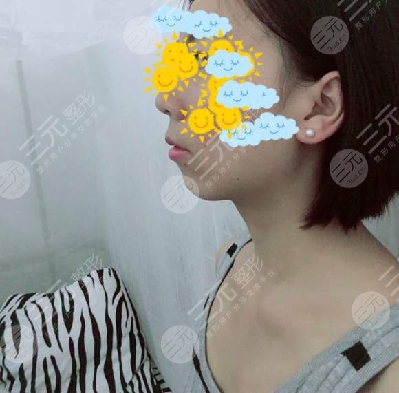 果酸祛痘做几次见