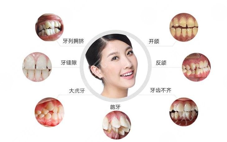 牙齿矫正年龄阶段