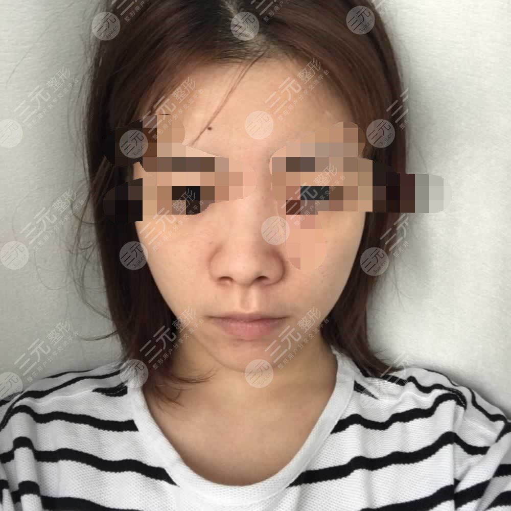 隆鼻前后对比果图片