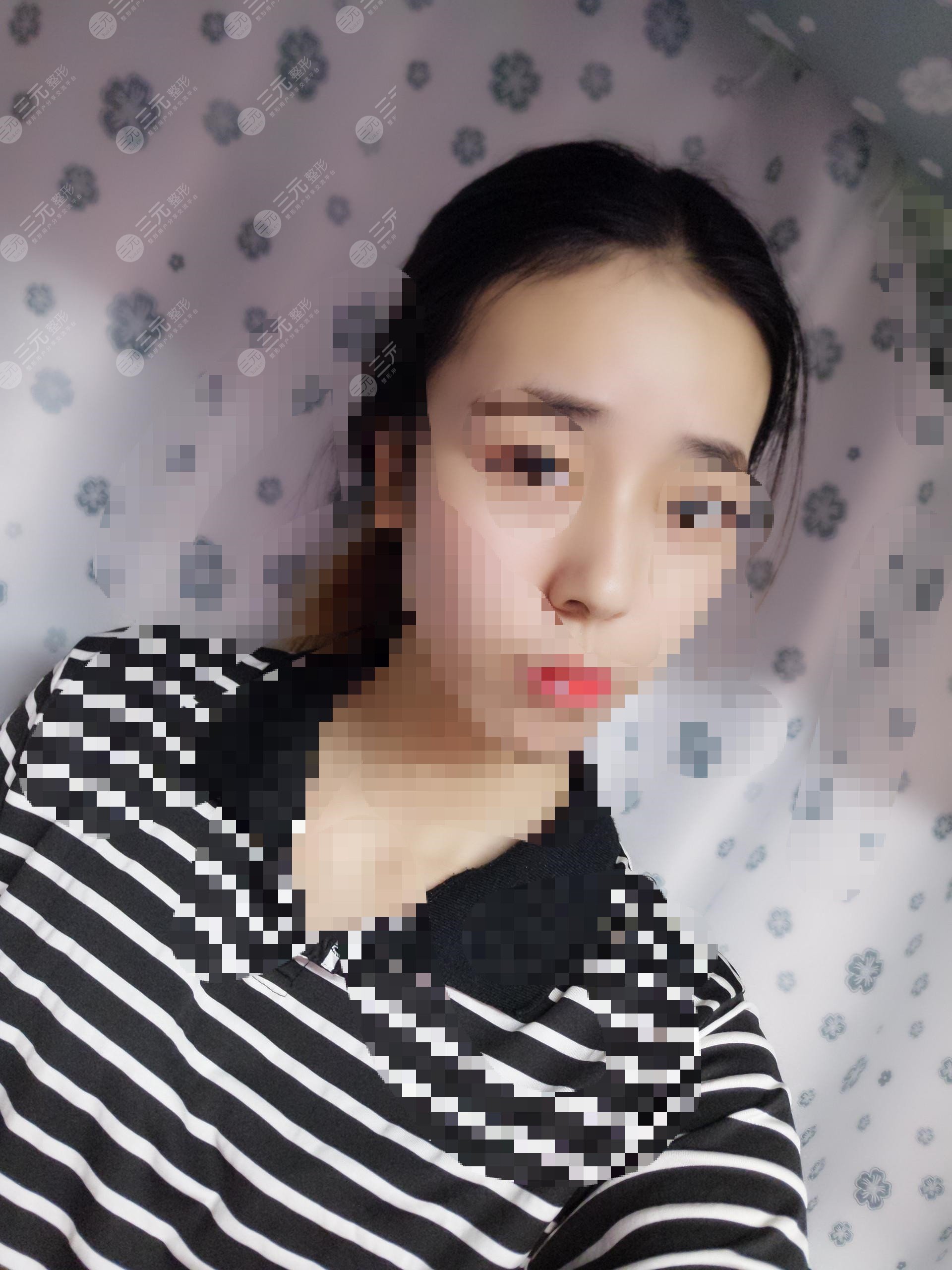 隆鼻前后对比果图片