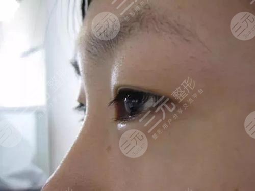 汪立川双眼皮怎么样