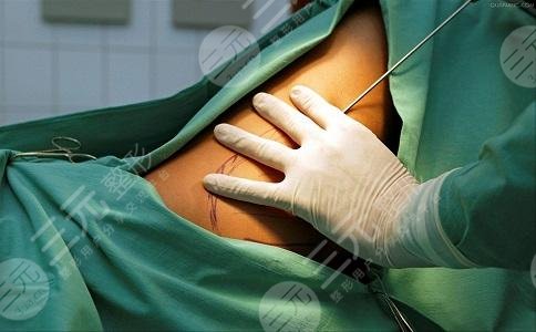 腰腹环吸水动力多久恢复正常果怎么样来瞧瞧真实图片吧