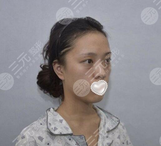 面部脂肪填充案例