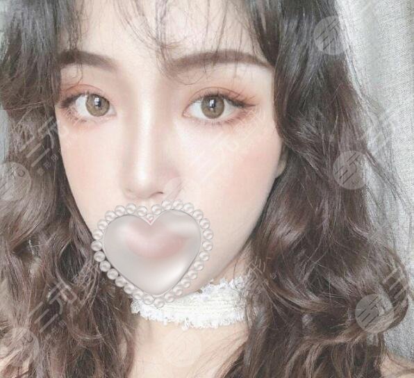 面部脂肪填充案例