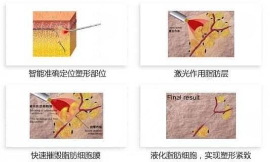 面部溶脂原理