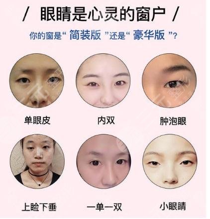 什么样的眼睛适合全切双眼皮