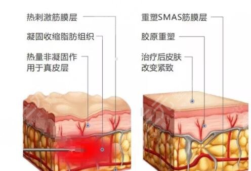 像素射频除皱的作用原理