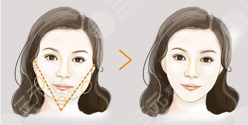 注射瘦脸是打50还是100剂量？每个人面部情况不一样，可别在稀里糊涂啦！