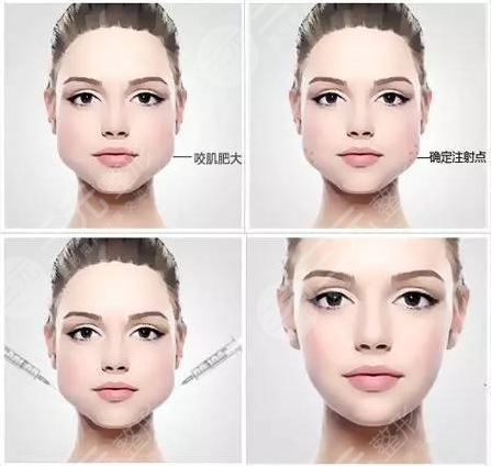 注射瘦脸是打50还是100剂量？每个人面部情况不一样，可别在稀里糊涂啦！