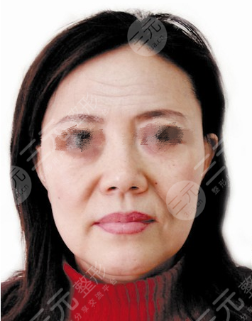 恩喜整形医院细胞重组安多果盘点【真人图】