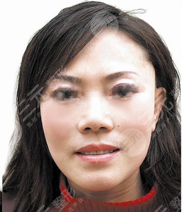 恩喜整形医院细胞重组安多果盘点【真人图】