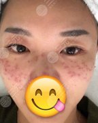 彩光祛斑三天后的照片!跟斑点说“拜拜” 彩光祛斑三天后的照片!跟斑点说“拜拜”