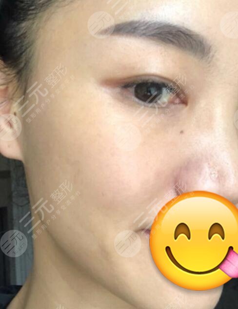 彩光祛斑三天后的照片!跟斑点说“拜拜”