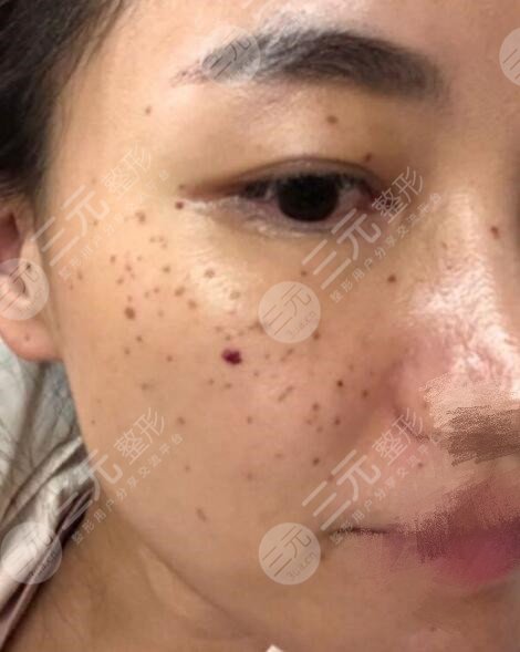 彩光祛斑三天后的照片!跟斑点说“拜拜”
