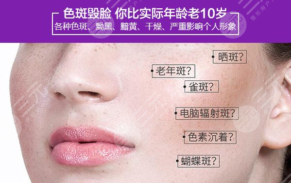 彩光祛斑三天后的照片!跟斑点说“拜拜”