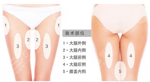 今天给大家科普一下腿部吸脂的人后来都怎么样了？