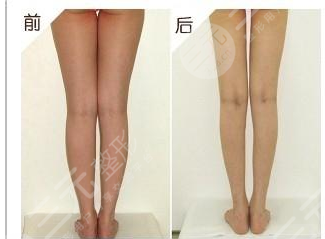今天给大家科普一下腿部吸脂的人后来都怎么样了？