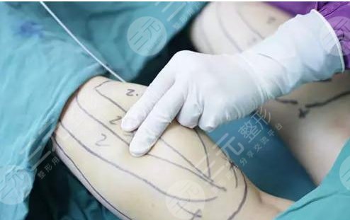 今天给大家科普一下腿部吸脂的人后来都怎么样了？