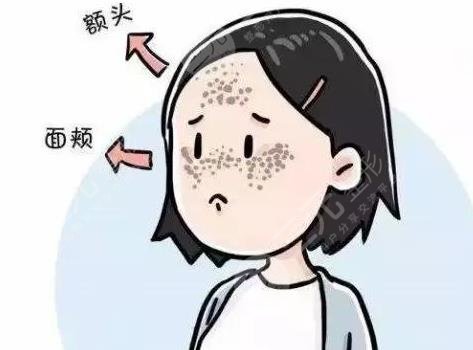 激光祛黄褐斑反多久可以恢复