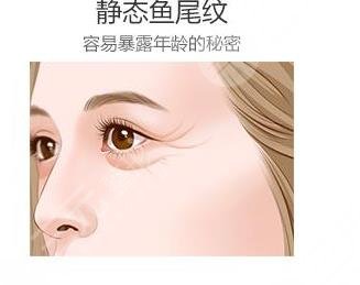 除鱼尾纹针能管多久