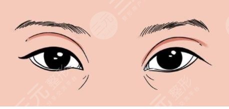 眼睑吸脂前后对比