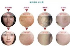 黑脸娃娃嫩肤疼吗？黑脸娃娃嫩肤后注意哪些?