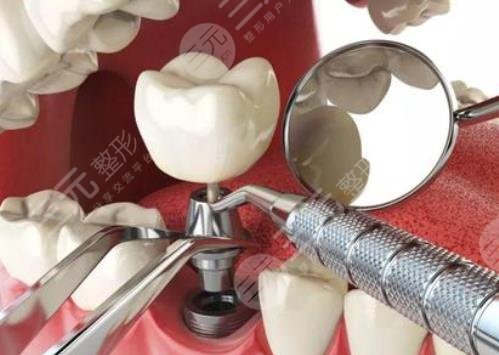 良心医生不建议种植牙?为什么?哪些人适合做种植牙?